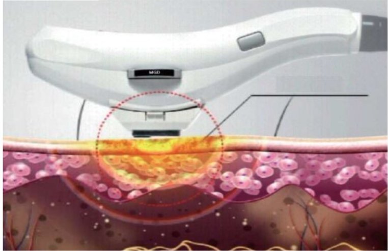 MGD治療装置（アクアセル）
