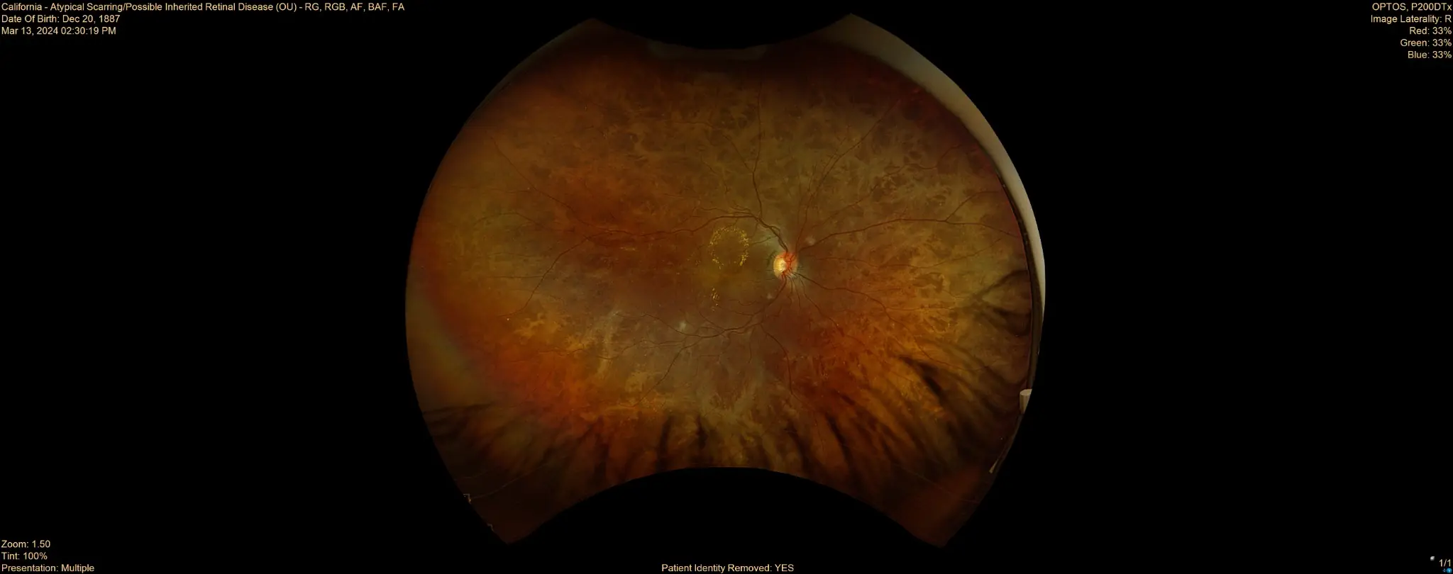 遺伝性網膜疾患の眼底画像サンプル