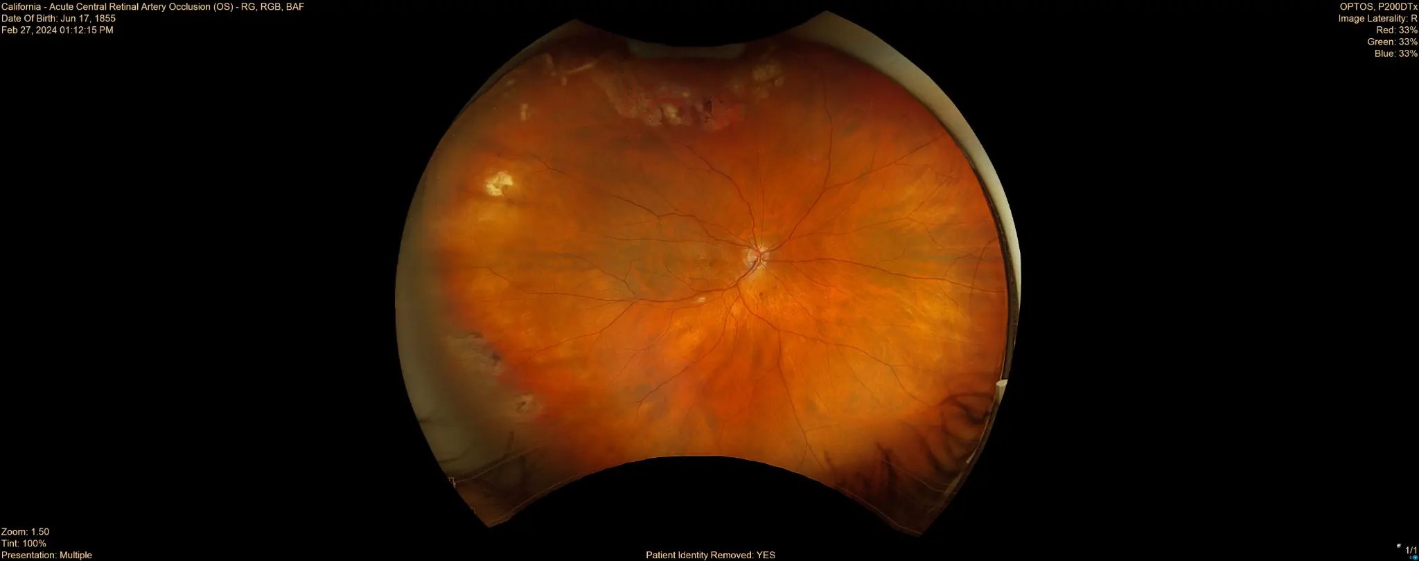 カリフォルニアRGB 眼底撮影画像サンプル